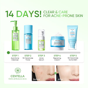 5PCS! Anti Acne Set