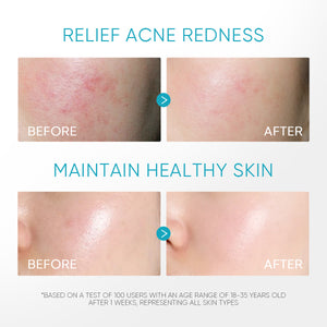 5% Panthenol Acne Calming Water Gel
