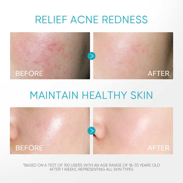 5% Panthenol Acne Calming Water Gel