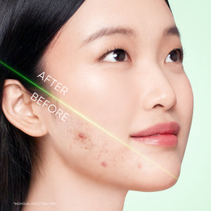 3X Acid Acne Gel Cleanser