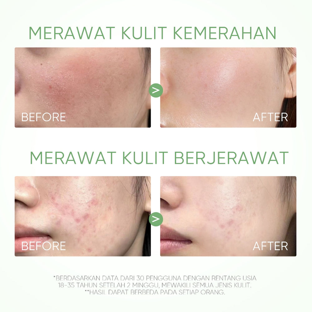 Mugwort Acne Clay Stick Acne Treatment