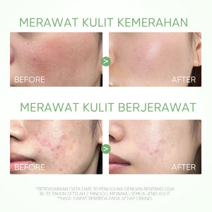 Mugwort Acne Clay Stick Acne Treatment