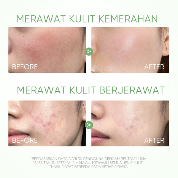 Mugwort Acne Clay Stick Acne Treatment